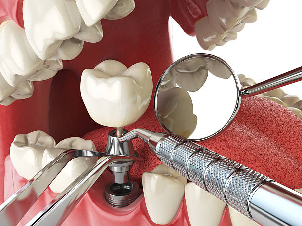 Best Emergency Dental Care for Broken or Chipped Teeth in Post Falls, ID